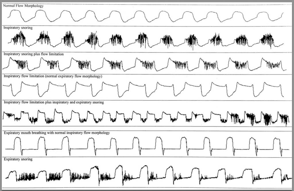 Cpap Flow Rate Chart